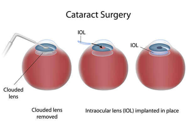 Cataract Surgery Albuquerque Cataract Surgery Diagram