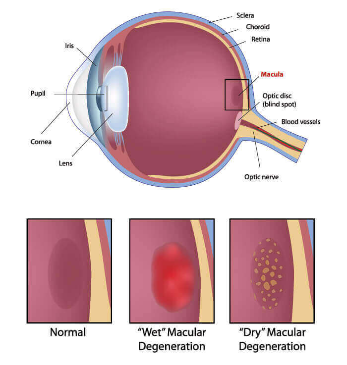 Macular Degeneration Albuquerque Diagram Showing What Macular Degeneration Looks Like in The Eye