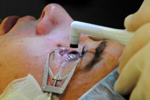 LASIK surgery procedure